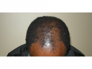 African American Hair Transplant Houston | Hair Restoration Houston