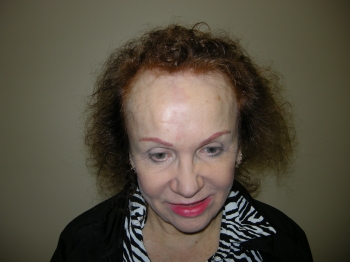 Female Hair Restoration In Houston