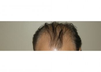 Men’s Hair Loss Procedure In Houston