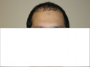 Men's Hair Loss Solution In Houston | Hair Restoration Houston