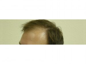 Men's Hair Loss Surgery |  Hair Restoration Houston