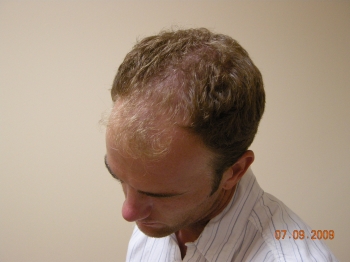 Men’s Hair Loss Treatment In Houston