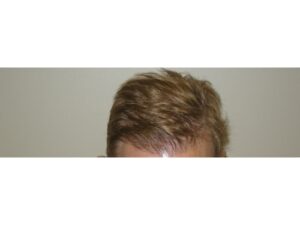Male Hair Restoration Houston