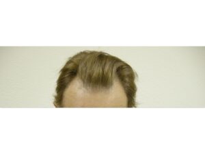 Male Hair Restoration Houston | Hair Restoration Houston