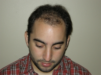 Hair Restoration Procedure In Houston