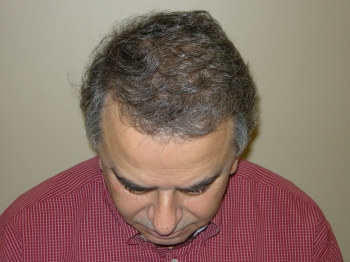 Hair Restoration Results Houston