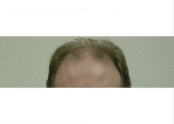 Male Hair Restoration Surgery In Houston