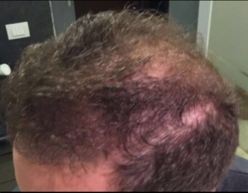 Male Hair Transplant Surgery Results