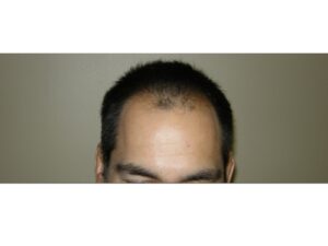 Men's Hair Transplants In Houston | Hair Restoration Houston