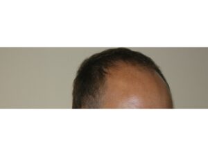 Men's Hair Transplant Surgery | Hair Restoration Houston