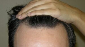 Houston Hair Transplant For Men | Hair Restoration Houston
