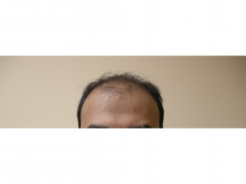 Male Hair Restoration In Houston