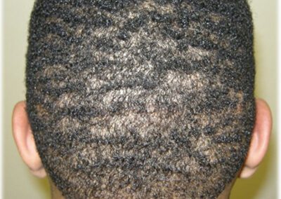 African American Male Hair Restoration