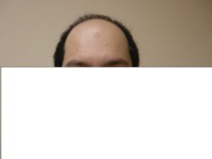 Men's Hair Loss Solution In Houston | Hair Restoration Houston